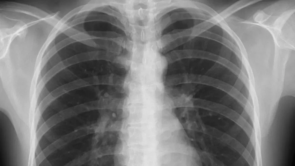 Chest X-ray of an adult male.