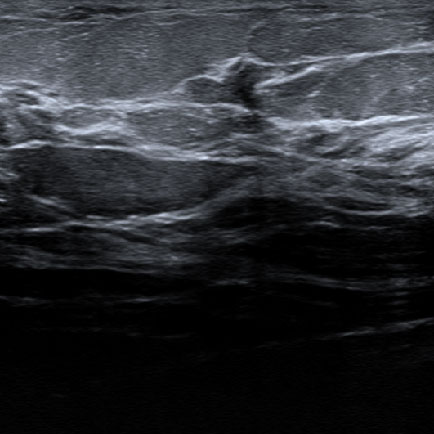 AI Can Reduce Overdiagnosis in Ultrasound Screening for Breast
