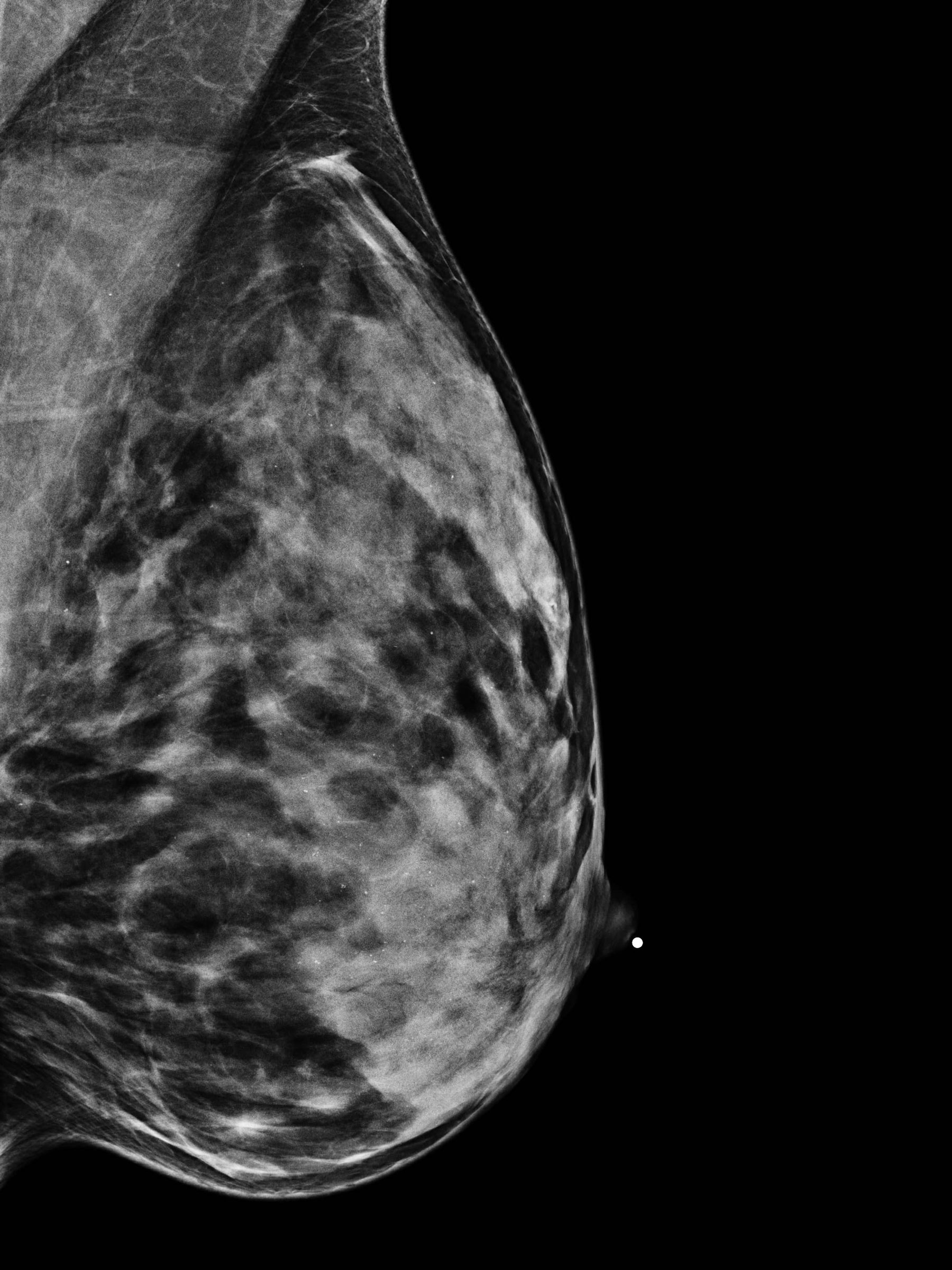 AI Can Reduce Overdiagnosis in Ultrasound Screening for Breast