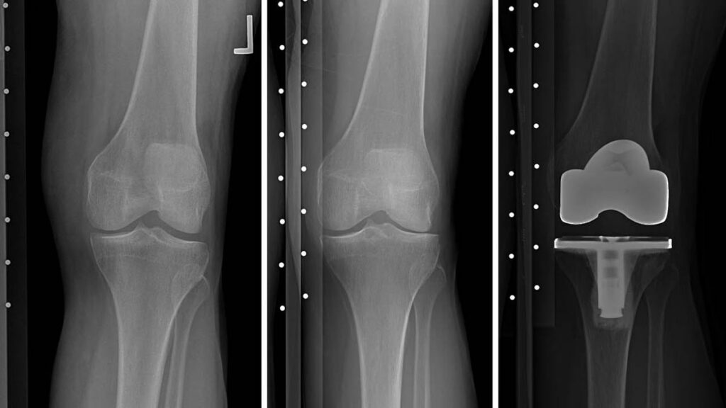 X-ray images of a knee before and after a total knee replacement.