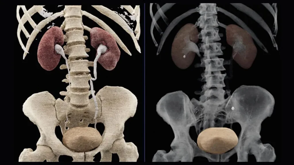 A surface rendering of the kidneys, ureters, and bladder.