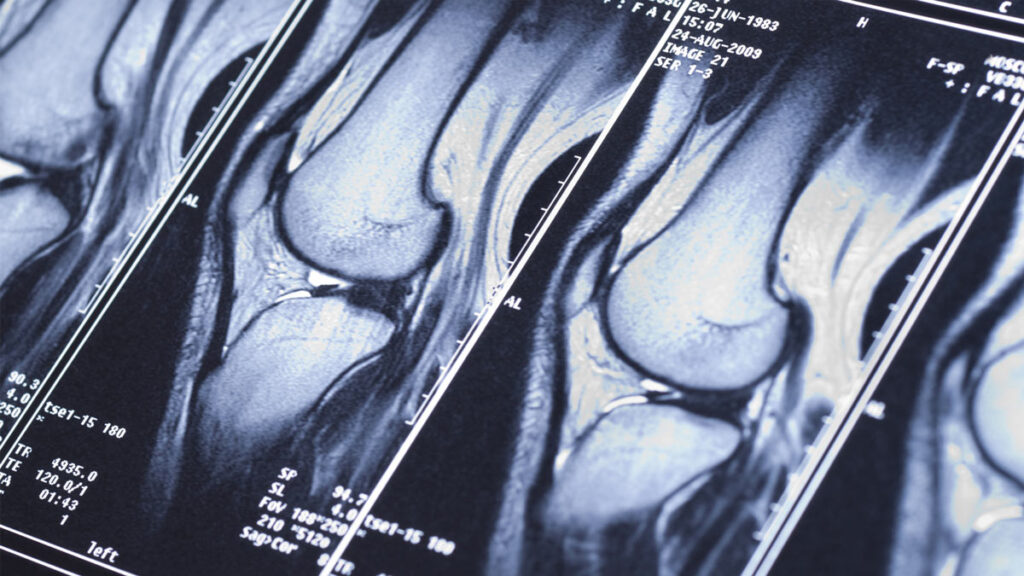Photo: MRI of the knee.