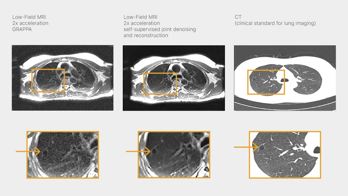Comparison of axial lung images acquired with a reference low-field MRI method, new self-supervised joint denoising and reconstruction method, and CT, the clinical standard method.