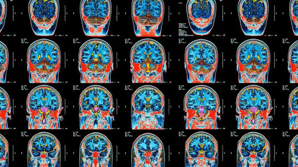 A series of segmented brain scans.