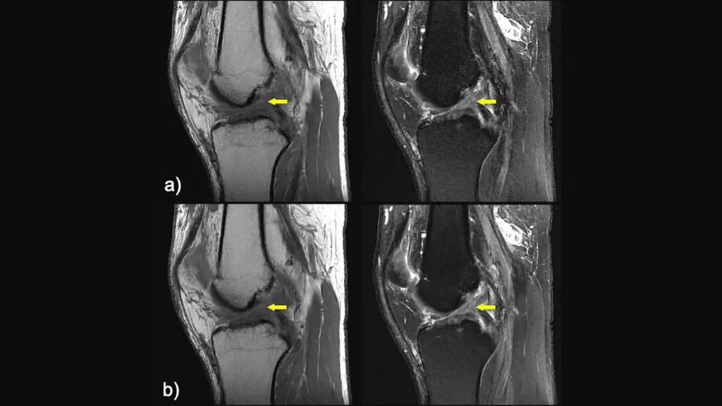 A four-panel set of MR images of the knee.
