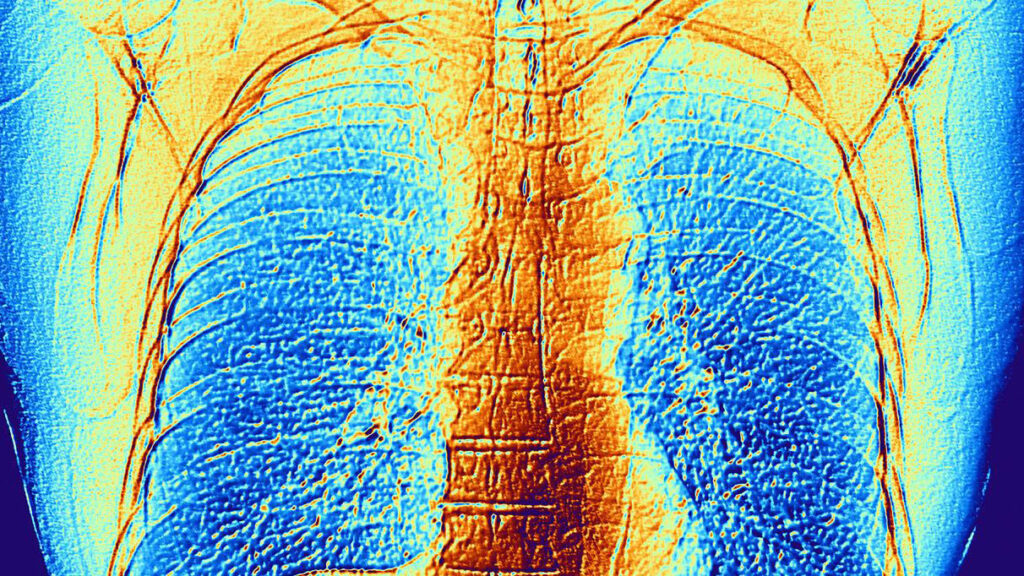 Colorized image of a chest scan.