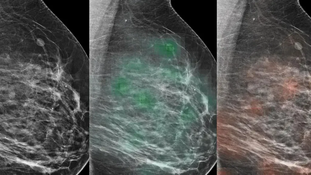 A triptych showing a mammogram next to one with a green heat map and another with a red heat map.
