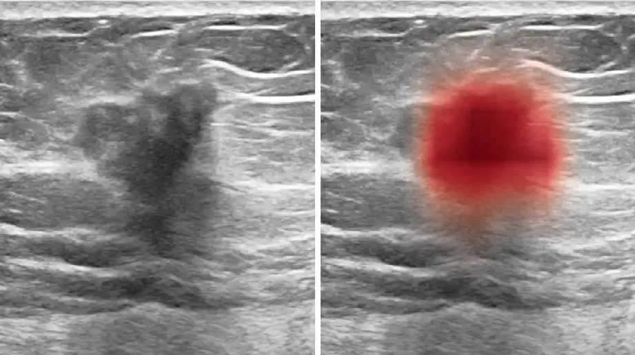A diptych showing an original ultrasound image next to the same image with a red heat map.