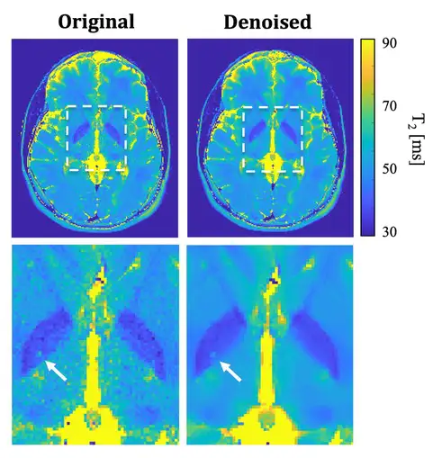 Example of MESE MRI data without and with MP-PCA denoising.