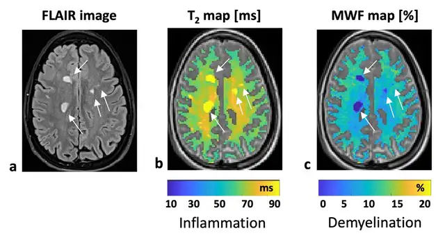 Example comparison of qualitative T2 weighted image and quantitative T2 relaxation mapping.